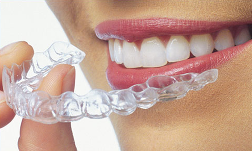 All You Need to Know About Clear Aligners